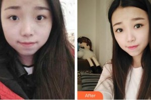 寧波愛爾光明眼科醫(yī)院曾慶森整形價格表附切開雙眼皮案例展示