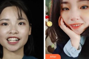 寧波現(xiàn)代口腔醫(yī)院賀露娜整形價格表附金屬托槽矯正案例展示