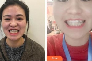 寧波現(xiàn)代口腔醫(yī)院孫丹飛整形價格表附牙齒隱形矯正案例展示