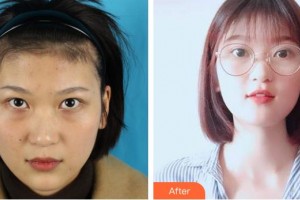 寧波市眼科醫(yī)院袁建樹整形價格表附內(nèi)切祛眼袋案例展示