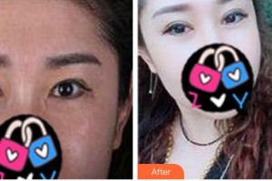 寧波市眼科醫(yī)院陳蔚整形價格表附眼部修復(fù)案例展示