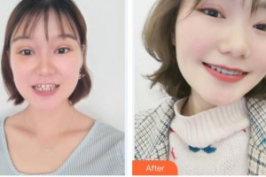 寧波鄞州協(xié)禾口腔醫(yī)院連麗琴整形價格表附隱形托槽矯正案例展示