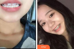 寧波鄞州協(xié)禾口腔醫(yī)院李燕娜整形價格表附金屬托槽矯正案例展示