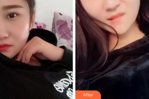 寧波鄞州協(xié)禾口腔醫(yī)院王昭文整形價格表附根管調(diào)節(jié)案例展示