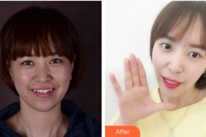 寧波鄞州德中口腔門診部何澤紅整形價格表附隱形托槽矯正案例展示