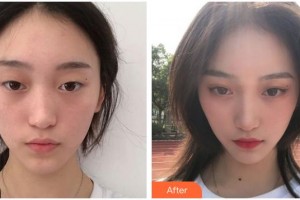 寧波明州醫(yī)院眼科李燕波整形價格表附眼部綜合案例展示