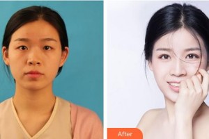 寧波明州醫(yī)院眼科周谷平整形價格表附眼部綜合案例展示