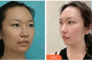 寧波市華慈醫(yī)院眼科周偉整形價格表附切開雙眼皮案例展示