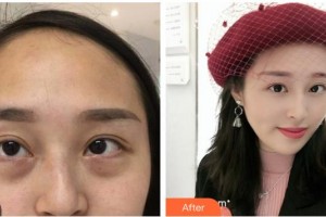 寧波市華慈醫(yī)院眼科劉艷婷整形價格表附內(nèi)切祛眼袋案例展示