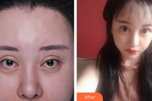 寧波市華慈醫(yī)院眼科張迎書整形價格表附眼部修復(fù)案例展示