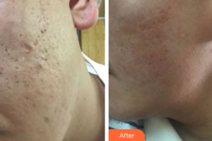 深圳麗港麗格醫(yī)療美容門診部舒暢整形價(jià)格表附微針淡化痘印案例展示