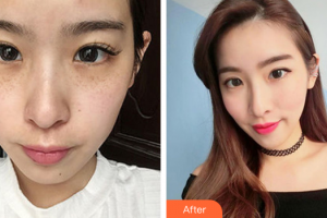 深圳麗港麗格醫(yī)療美容門診部易仁祥整形價(jià)格表附激光祛斑案例展示