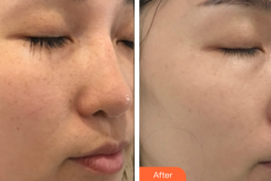 深圳韓佳醫(yī)療美容門診部王煥英整形價(jià)格表附多方面部較準(zhǔn)祛斑案例展示