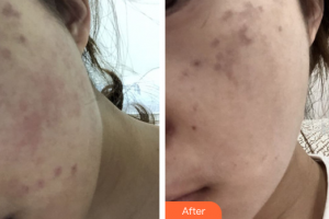 深圳春天海岸醫(yī)療美容門診部李康勇整形價(jià)格表附蜂巢激光美膚祛斑案例展示