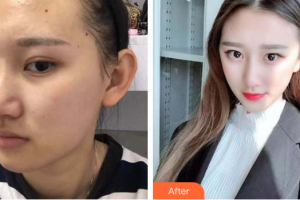 深圳韓佳醫(yī)療美容門診部周爽整形價(jià)格表附面部吸脂瘦臉案例展示