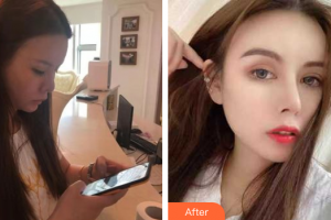 深圳幸福醫(yī)療美容門診部李丹陽整形價格表附假體豐眉弓案例展示