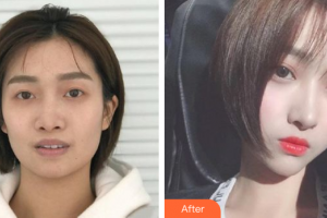 深圳博愛曙光醫(yī)院薛鐵華整形價格表附假體隆鼻案例展示