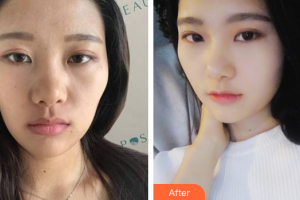 深圳鵬程醫(yī)院整形美容中心韓守義整形價格表附熱瑪吉案例展示