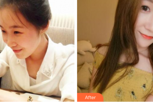 深圳鵬程醫(yī)院整形美容中心呂一斌整形價格表附熱瑪吉多方面部體驗案例展示