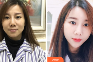 深圳瑞芙臣醫(yī)療美容門診部許金壽整形價格表附自體脂肪填充案例展示