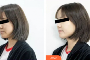 深圳鵬程醫(yī)院整形美容中心孫翠蓮整形價格表附激光美膚掃黃案例展示