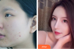 深圳鵬程醫(yī)院整形美容中心解慧慧住院醫(yī)師整形價格表附紅藍(lán)光祛痘案例展示