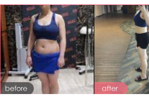 深圳鵬程醫(yī)院整形美容中心王君整形價格表附針灸瘦身案例展示