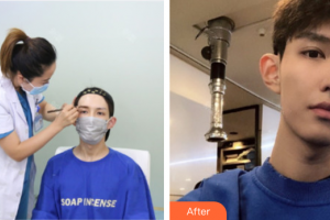 深圳鵬程醫(yī)院整形美容中心張小青整形價格表附種植眉毛案例展示