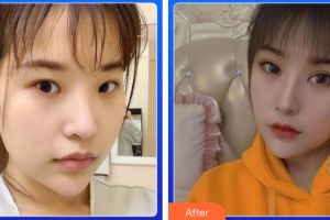 深圳美加美醫(yī)療美容門診部陳群整形價格表附雙眼皮案例展示