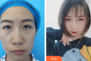 深圳西諾醫(yī)療美容門診部王美懿整形價格表附眼部綜合案例展示