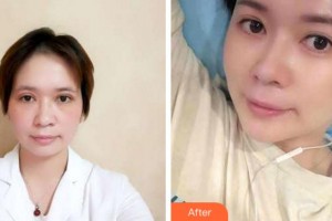 寧波藝星整形美容醫(yī)院潘炯波整形價格表附切開雙眼皮案例展示