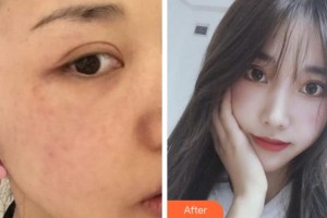 寧波藝星整形美容醫(yī)院崔晶瑩整形價格表附激光美膚激光案例展示