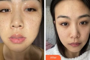 寧波澳瑪星光醫(yī)療美容診所杜愷整形價格表附祛斑案例展示