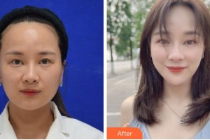 寧波澳瑪星光醫(yī)療美容診所唐田整形價格表附激光祛斑案例展示