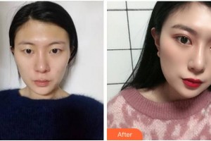 溫州和平整形醫(yī)院王煒整形價格表附切開雙眼皮案例展示