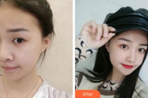 溫州雅美姬整形美容醫(yī)院李敏錫整形價格表附眼部綜合案例展示