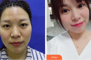 溫州雅美姬整形美容醫(yī)院金正泰整形價格表附切開雙眼皮案例展示