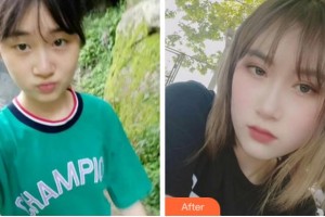 溫州和平整形醫(yī)院薛志輝整形價格表附眼部綜合案例展示