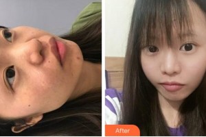 溫州和平整形醫(yī)院朱楓整形價格表附手術祛疤案例展示