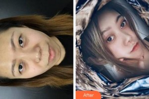 溫州和平整形醫(yī)院邵晉整形價格表附雙眼皮案例展示