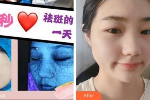 溫州同德醫(yī)院整形美容中心盧麗萍整形價格表附激光祛斑案例展示
