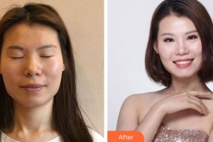 溫州藝星醫(yī)學美容醫(yī)院李春新整形價格表附眼部整形案例展示