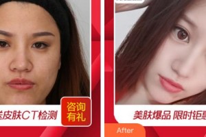 溫州芘麗芙美容醫(yī)院馮琳整形價格表附淡斑美白案例展示