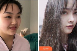 溫州藝星醫(yī)學美容醫(yī)院新倉辛一整形價格表附術前眼皮松弛案例展示