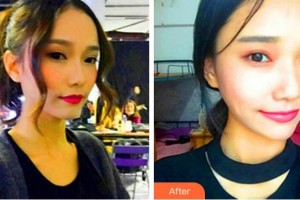 溫州藝星醫(yī)學美容醫(yī)院李杰整形價格表附熱瑪吉案例展示