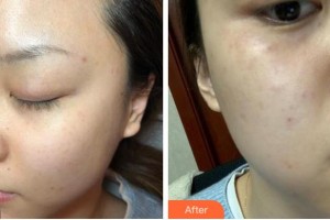 溫州星范醫(yī)學美容門診部陳乃波整形價格表附激光祛斑案例展示