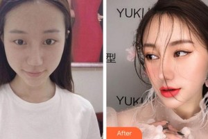 溫州藝星醫(yī)學美容醫(yī)院黃澤春整形價格表附眼部綜合案例展示