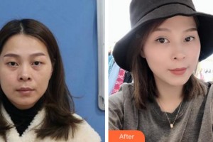 溫州解放軍118醫(yī)院整形科羅興華整形價(jià)格表附眼部整形案例展示