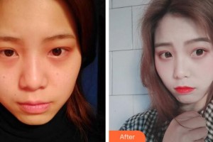 溫州雅美姬整形美容醫(yī)院丁愛華整形價(jià)格表附激光美膚祛斑案例展示