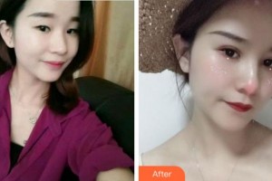 溫州藝星醫(yī)學(xué)美容醫(yī)院許炎龍整形價(jià)格表附眼部綜合案例展示